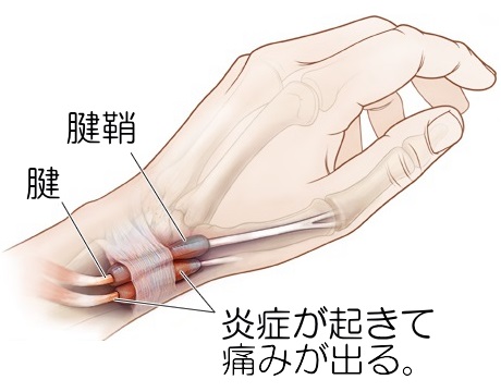 腱鞘炎 手首の痛み 福岡市博多の整体 ブルームカイロプラクティック